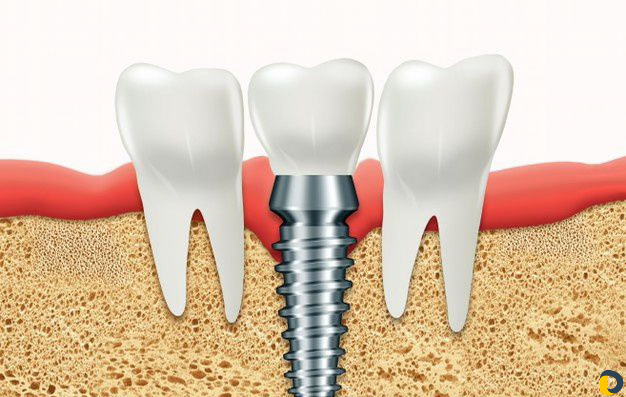 Имплантация зубов вывеска